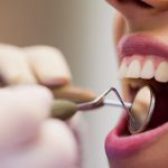 همه آنچه درباره جرمگیری دندان‌ها باید بدانید